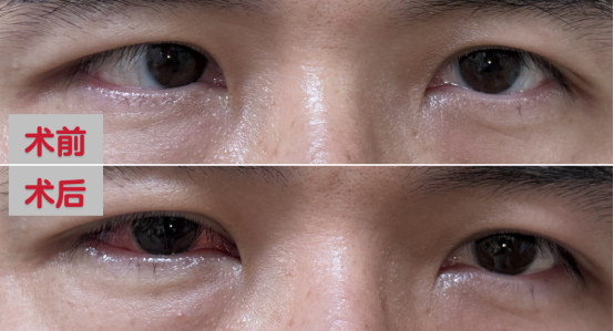 男子假期猛刷手机刷出“斗鸡眼”看东西重影！医生：避免高强度近距离用眼(图3)